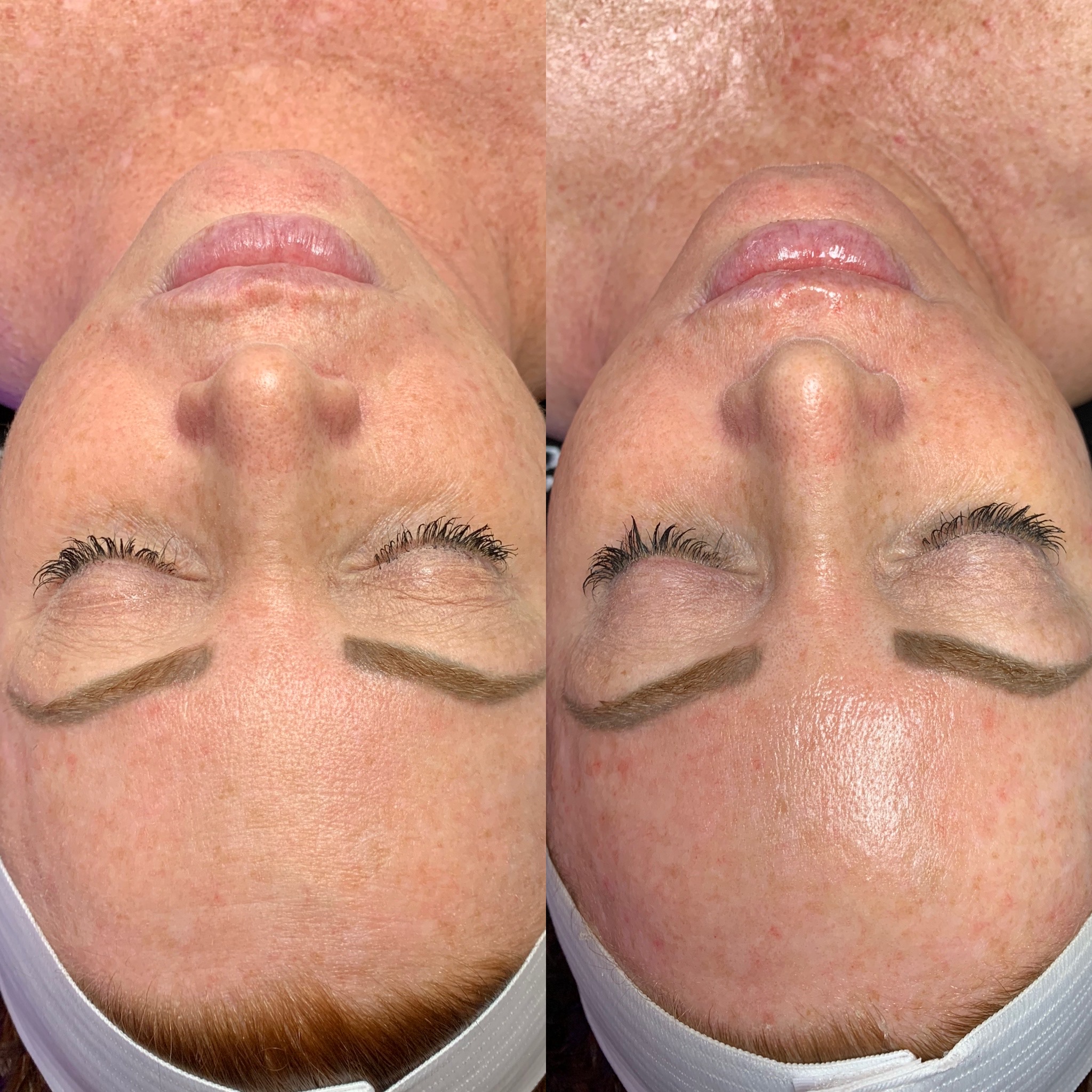 Hydrafacial SkinVolution GLENDALE AZ