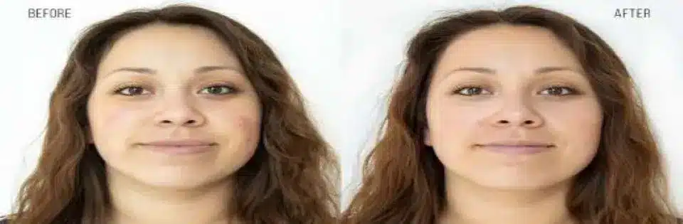 1768248656_45caeac587174963831b490419171208 Hydrafacial