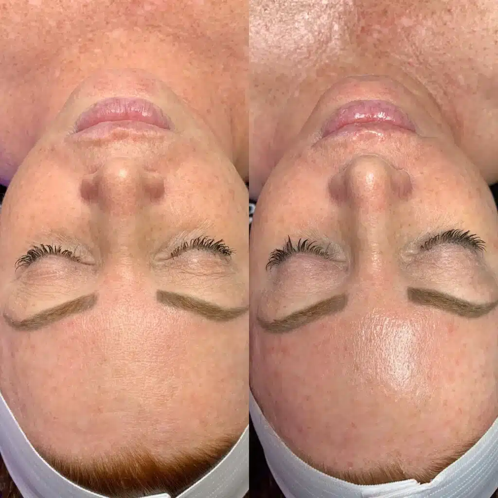 1768248666_b15f26fc7b00415b9009ac2ede676715 Hydrafacial