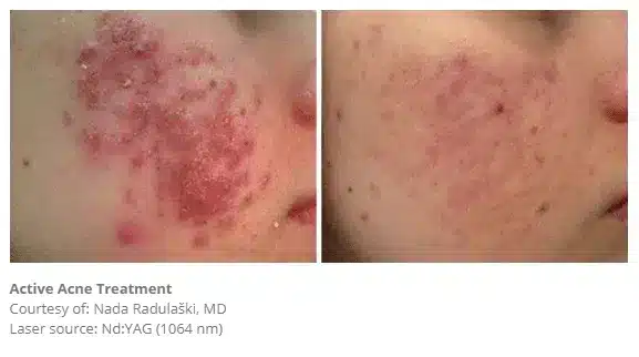 1768248742_b4b0400934914017b15ae401843b4306 Acne Treatment