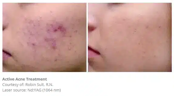 1768248744_52b844057ae04ce2bf5d1f3ab951a51b Acne Treatment