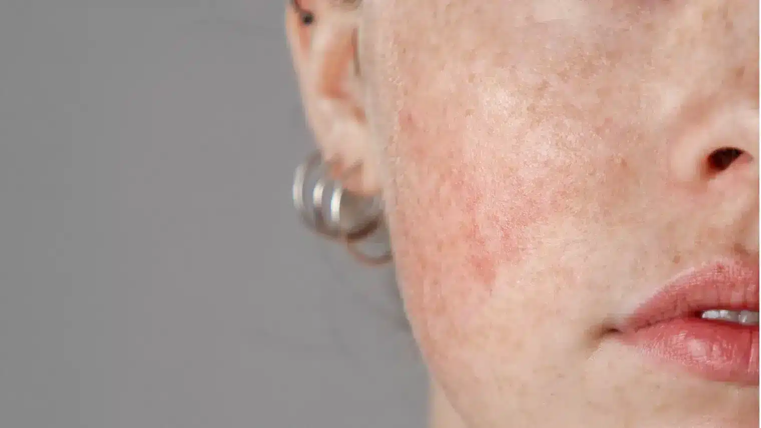 1768248748_60b17efc95a144e9802810b3287d50f2 Acne Treatment