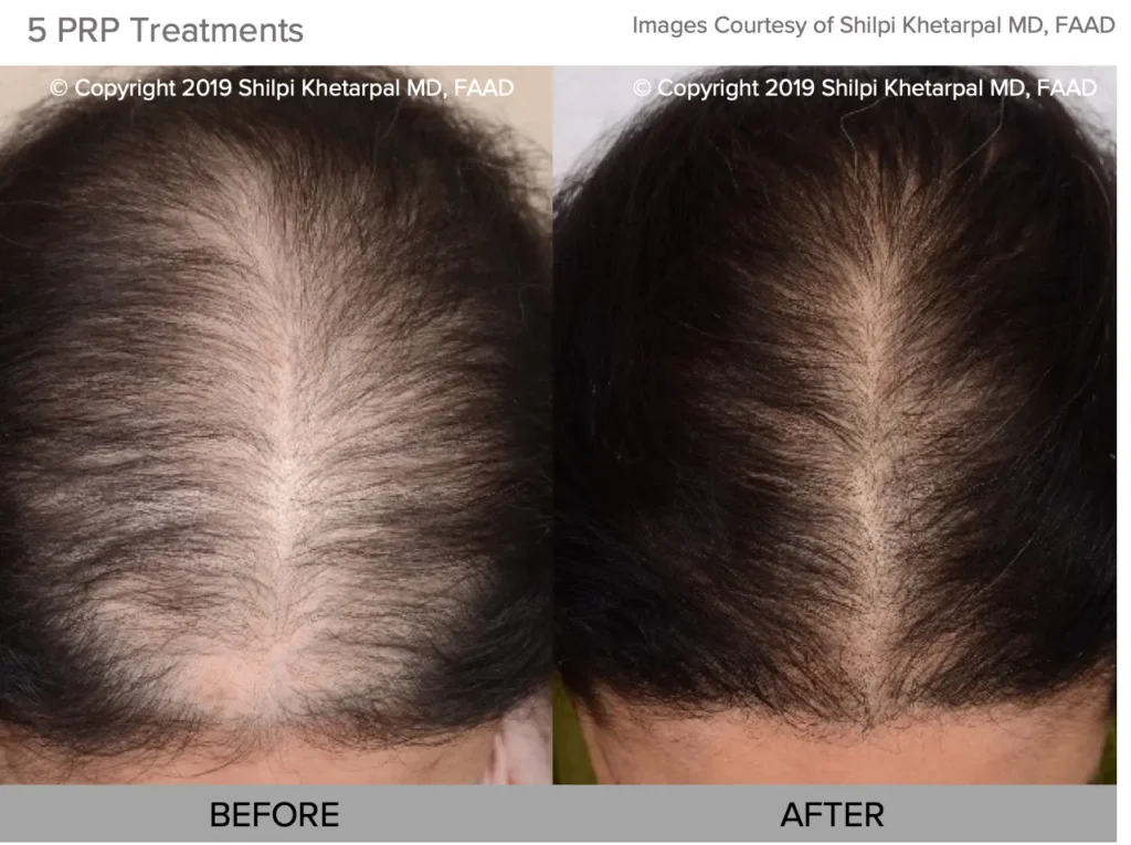 1768248767_9cc5c64a4799492985a47cc99d8ce37d Hair Regrowth Treatment