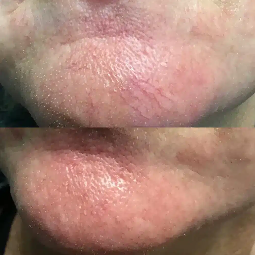 1768248838_1a51ab76f6b141599958c082c1aaae9b Laser Vein and Vascular Lesion Removal