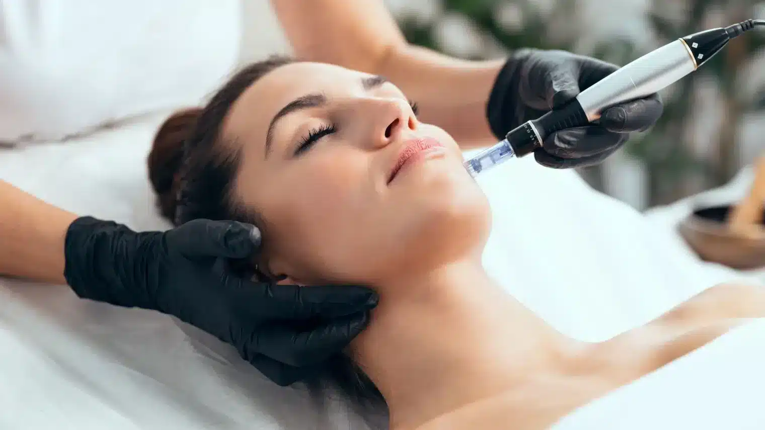 1768248849_5ed4c4f3d3ce4149a4ee84c206cb1842 Microneedling