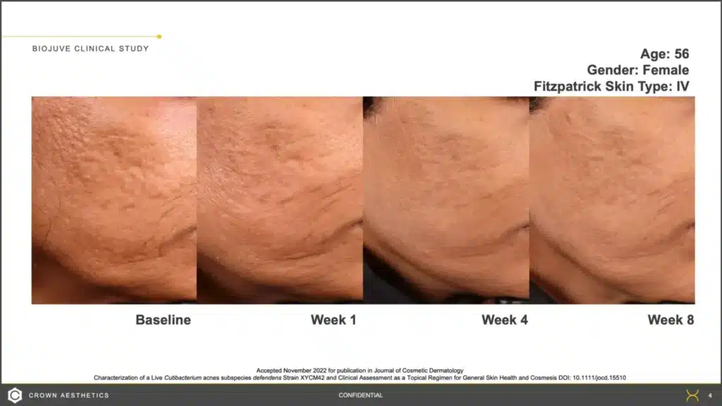 1768248864_bdf03105bd3446509572ac2df4530c39 Microneedling