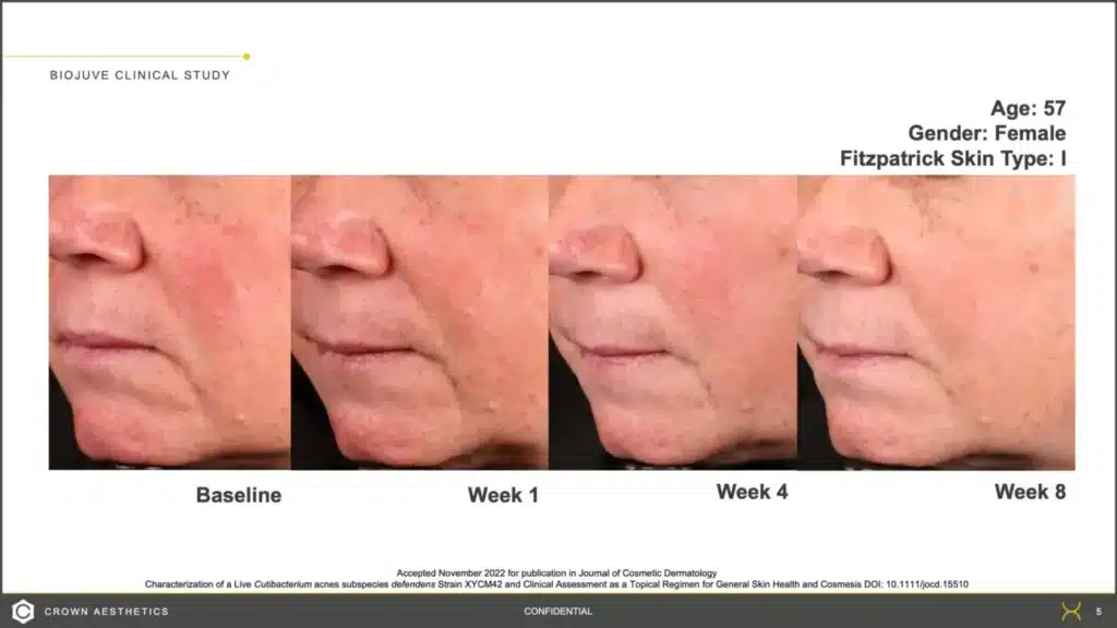 1768248873_c9117b404ddc4457aeb641810470a227 Microneedling