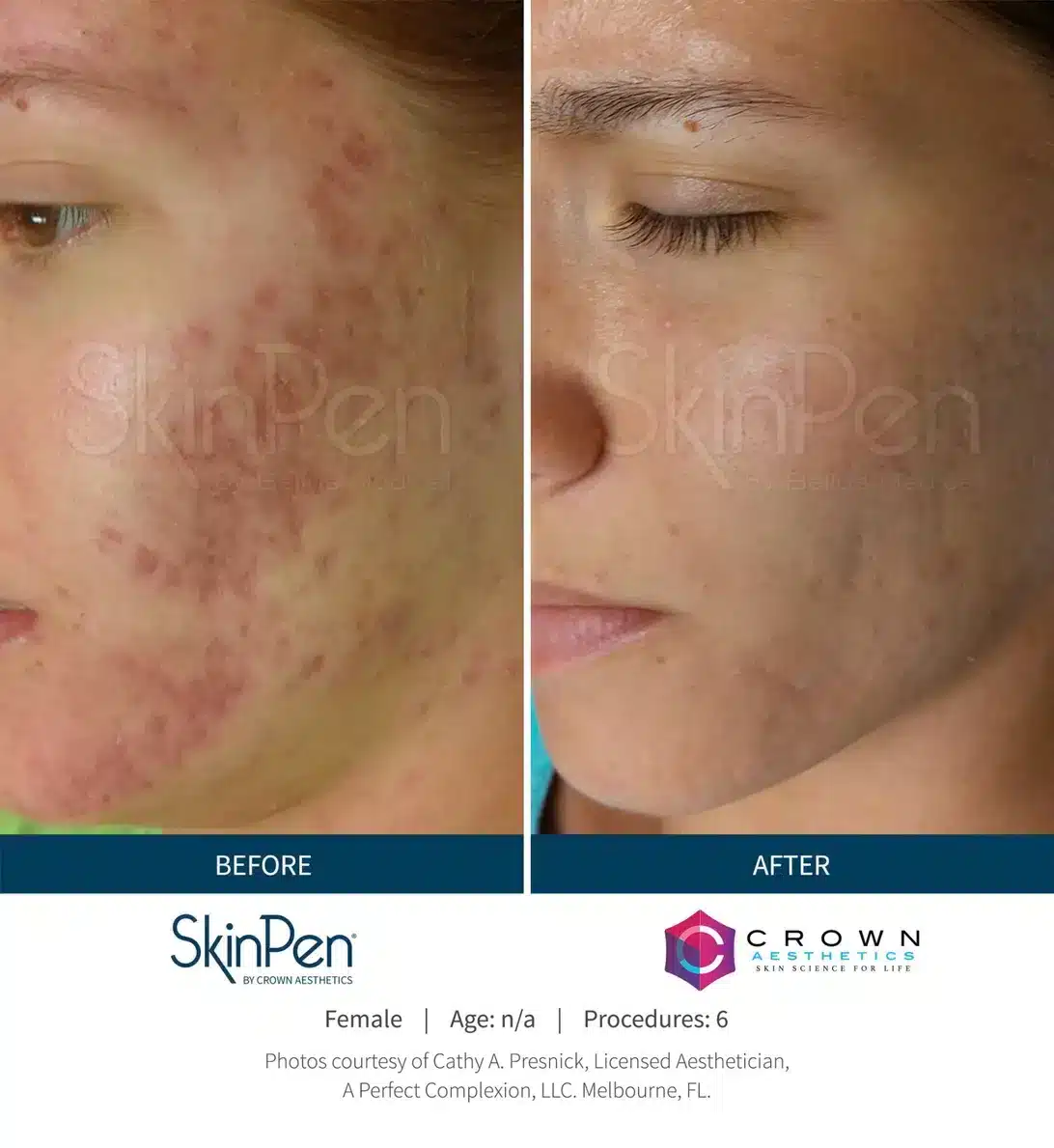 1768248877_ef974c1af10e472eb36fcb2d48cd42f8 Microneedling