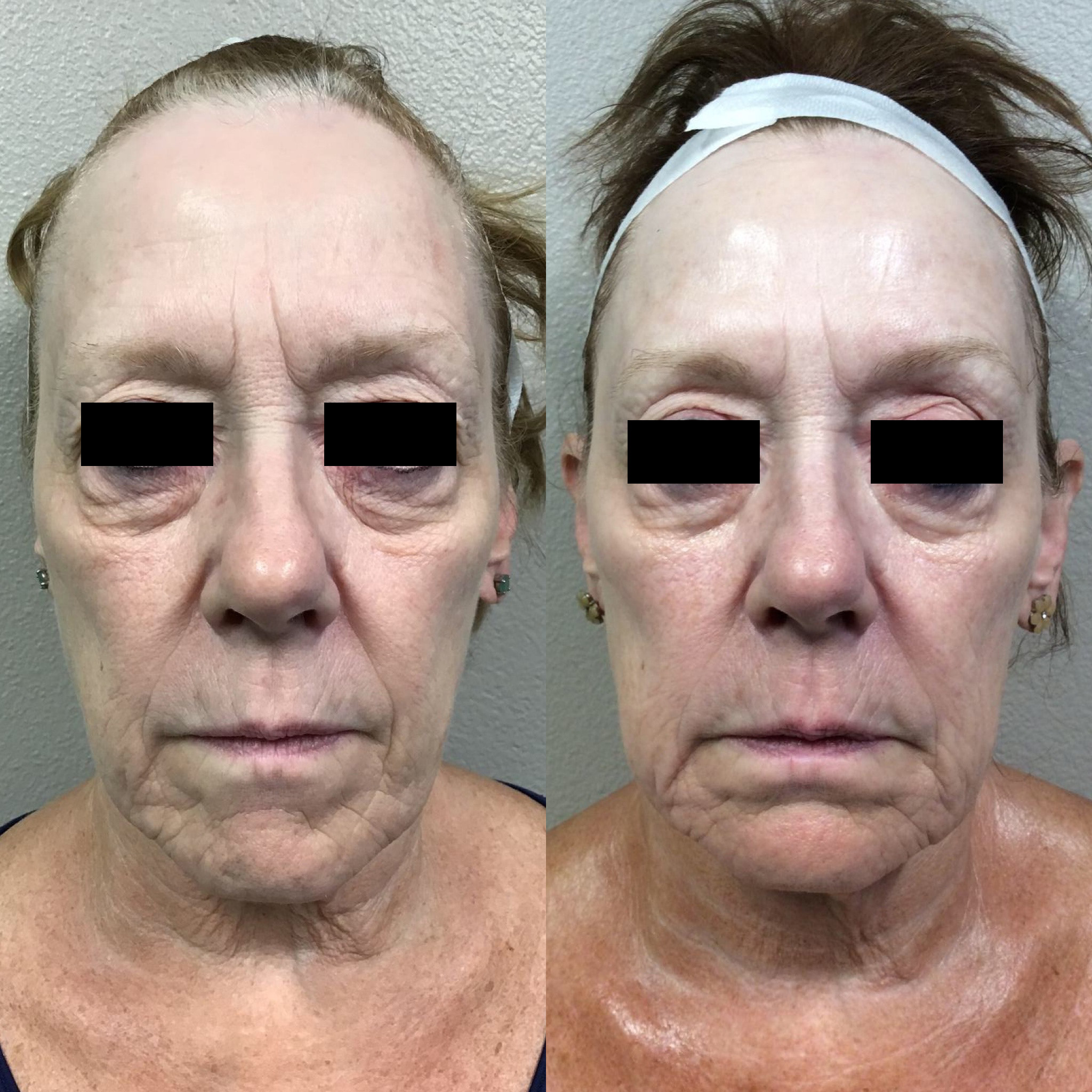 Before and After Image: 4D Laser Facelift - front