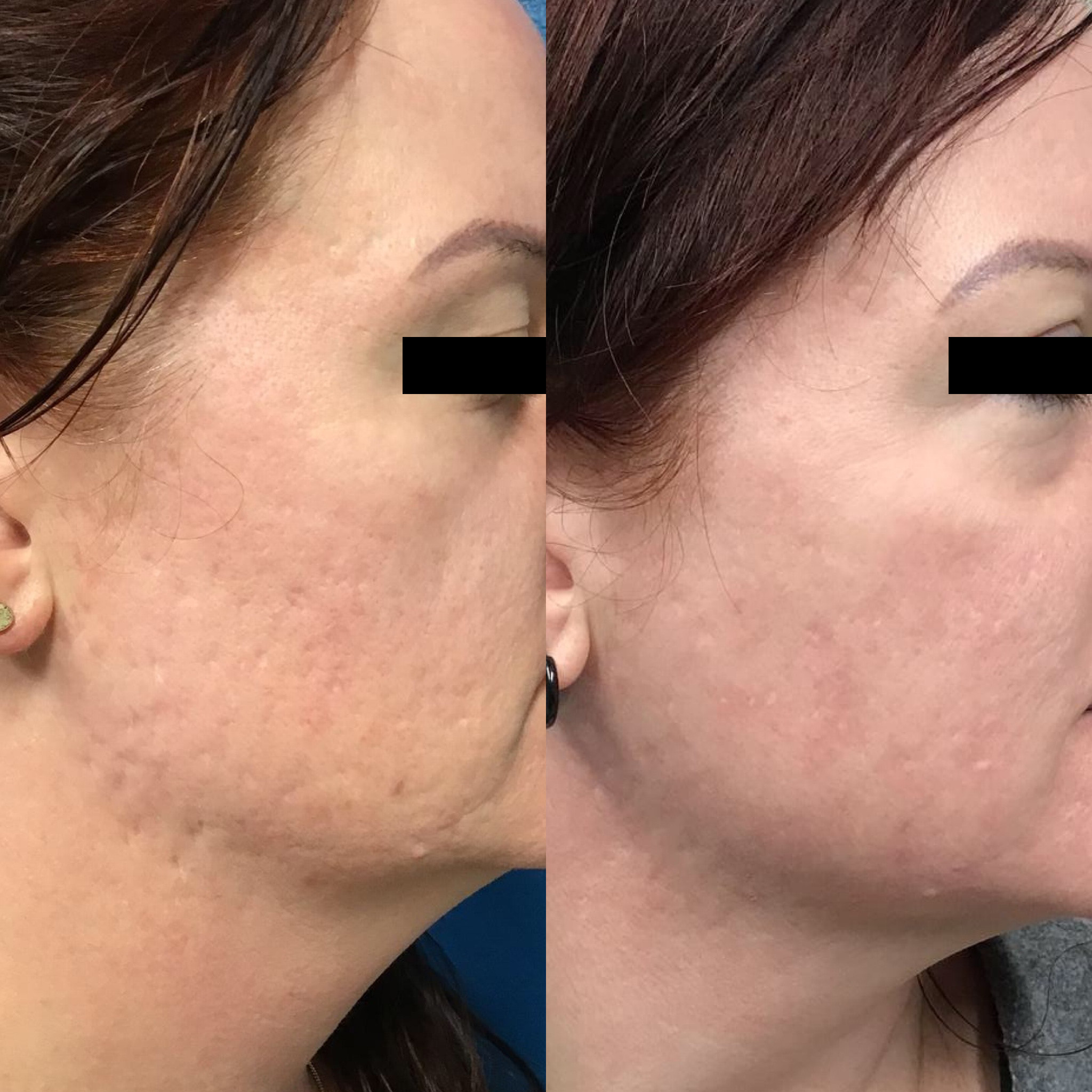 Before and After Image: Acne Laser Scar Revision - right-side