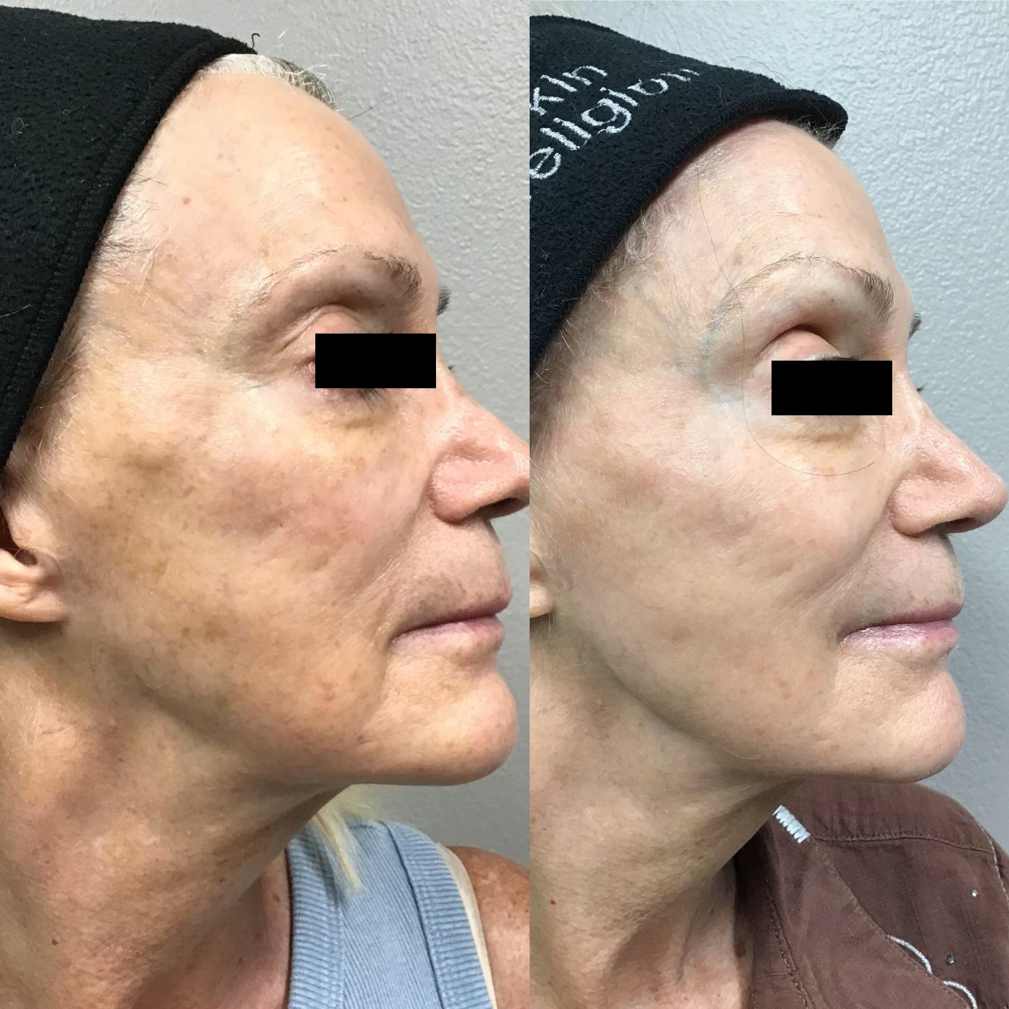 Before and After Image: Fotona Laser Peel - right-side