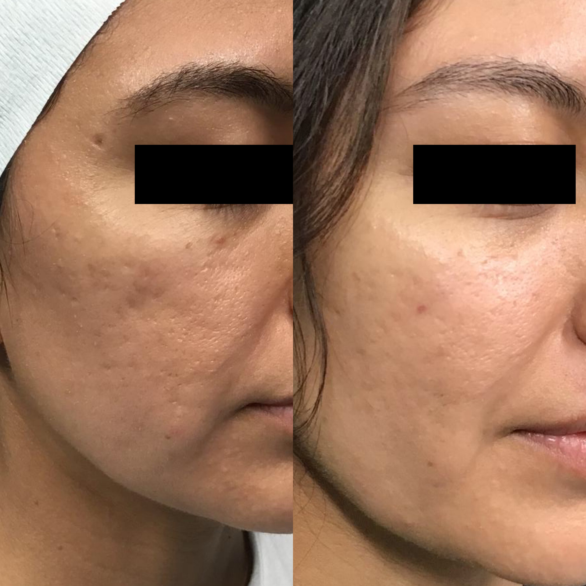Before and After Image: Microneedling with PRP - right-front-oblique