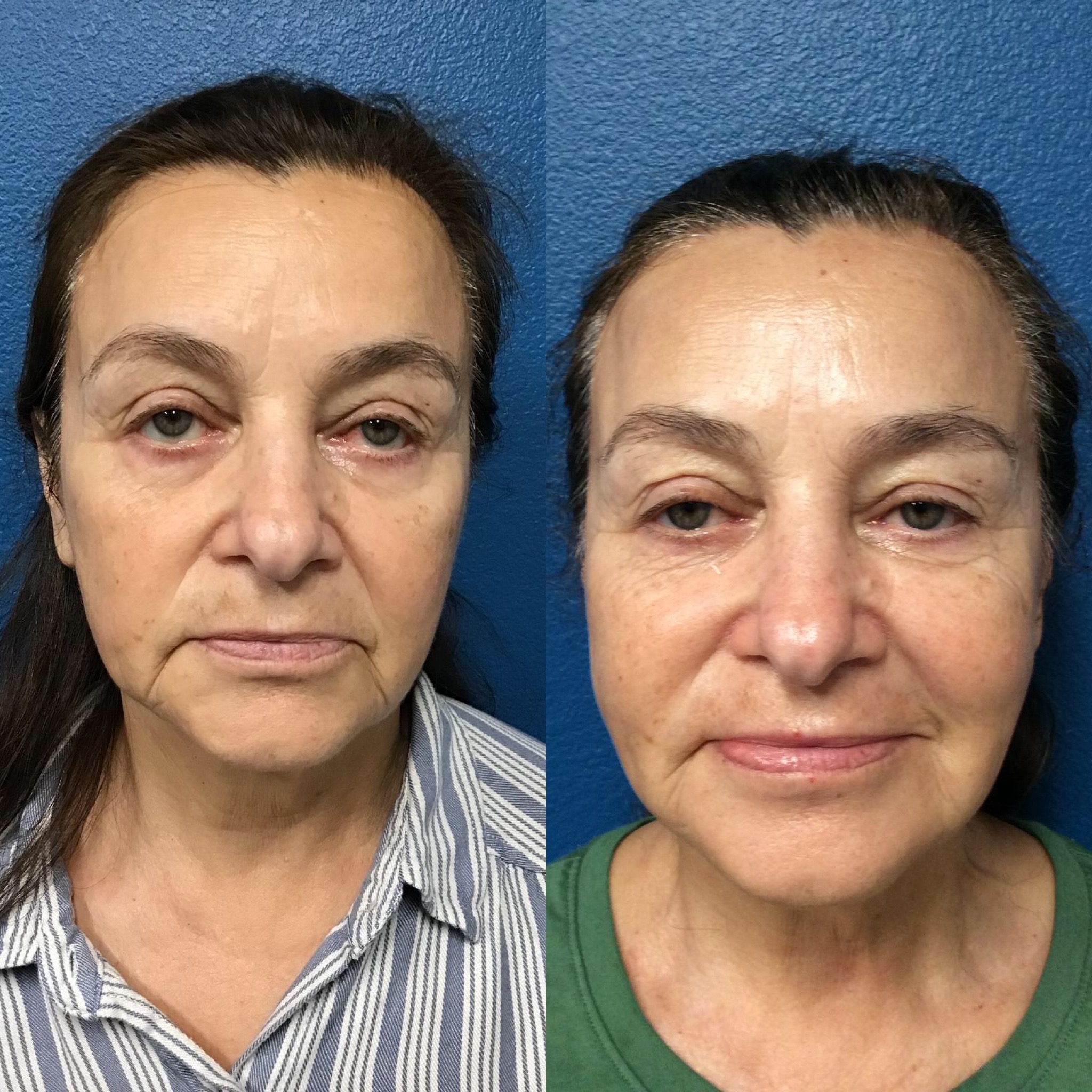 Before and After Image: Pearl Finish Laser Peel - front