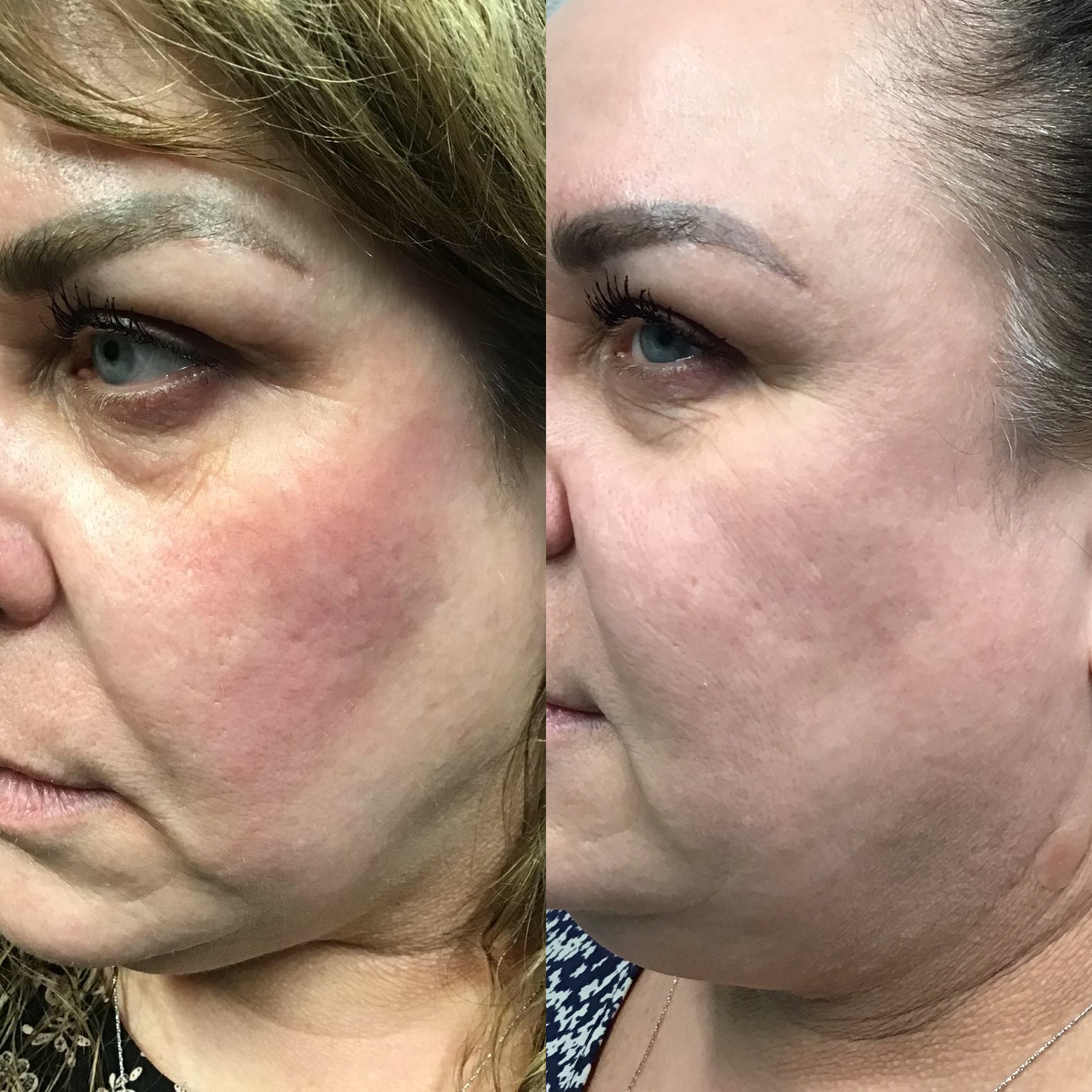 Before and After Image: Pearl Finish Laser Peel - left-front-oblique