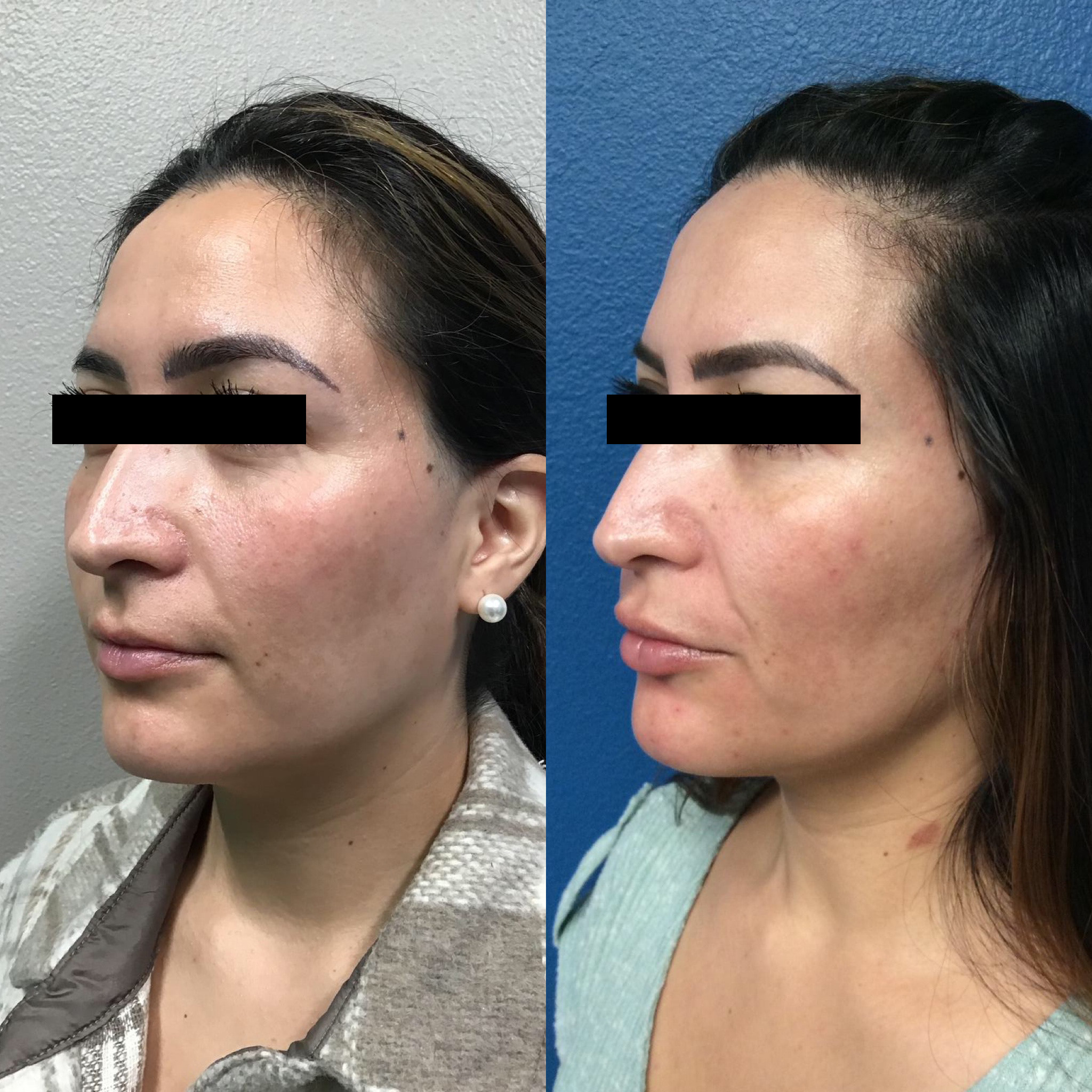 Before and After Image: Acne Laser Treatment - left-front-oblique