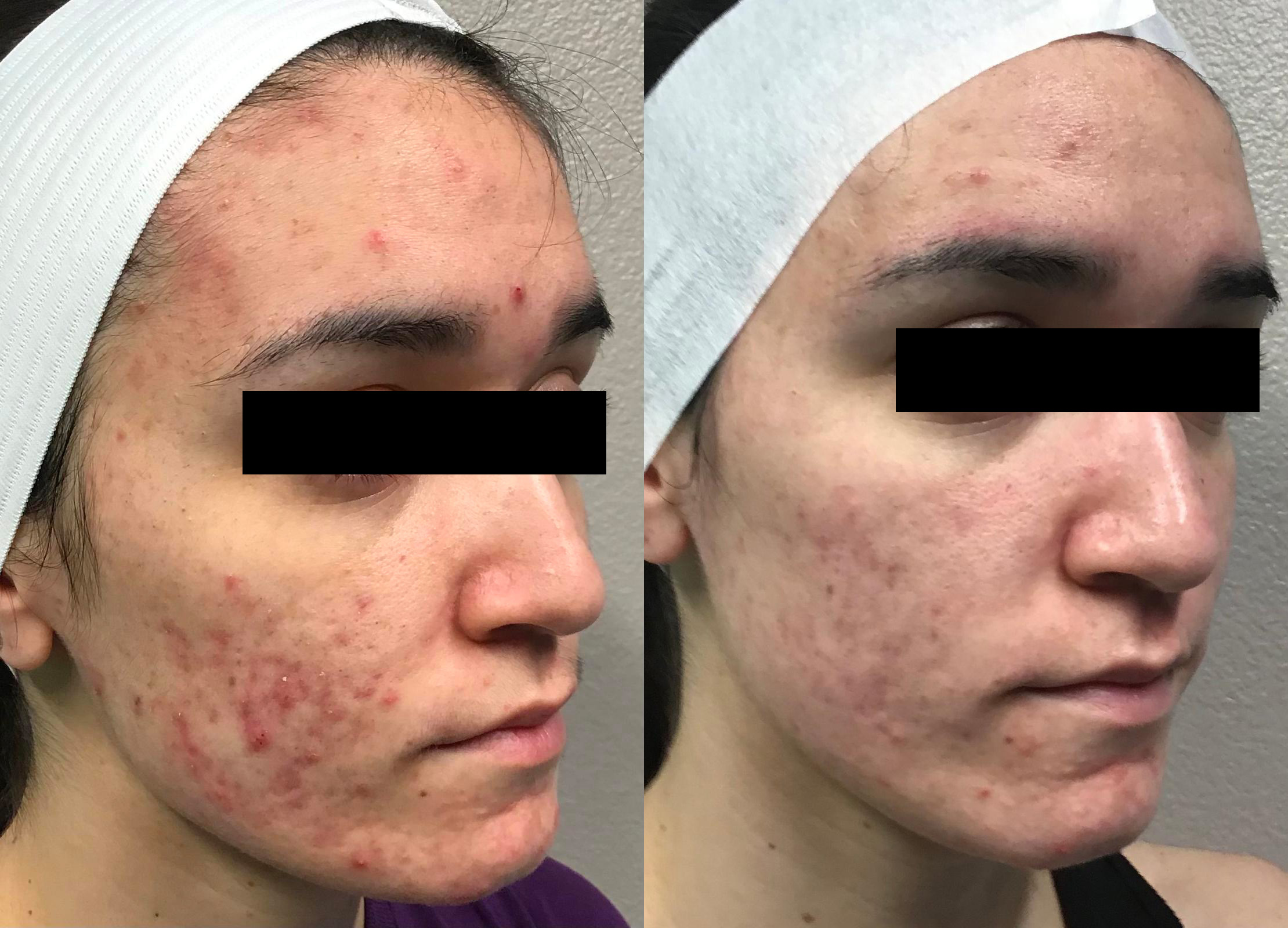Before and After Image: Acne Laser Treatment - right-front-oblique