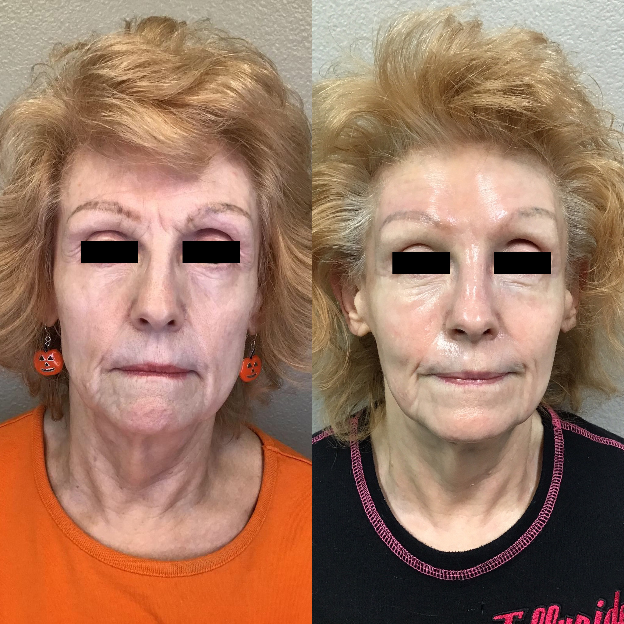 Before and After Image: Fotona 4D Non-Invasive Laser Facelift - front