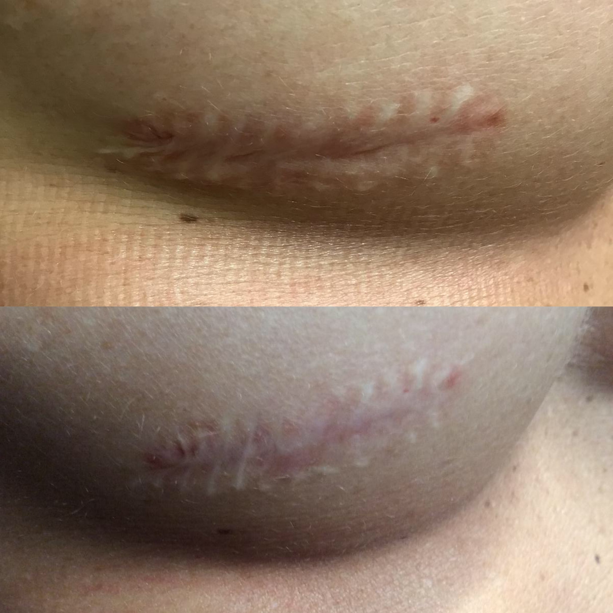 Before and After Image: Laser Scar Revision - front