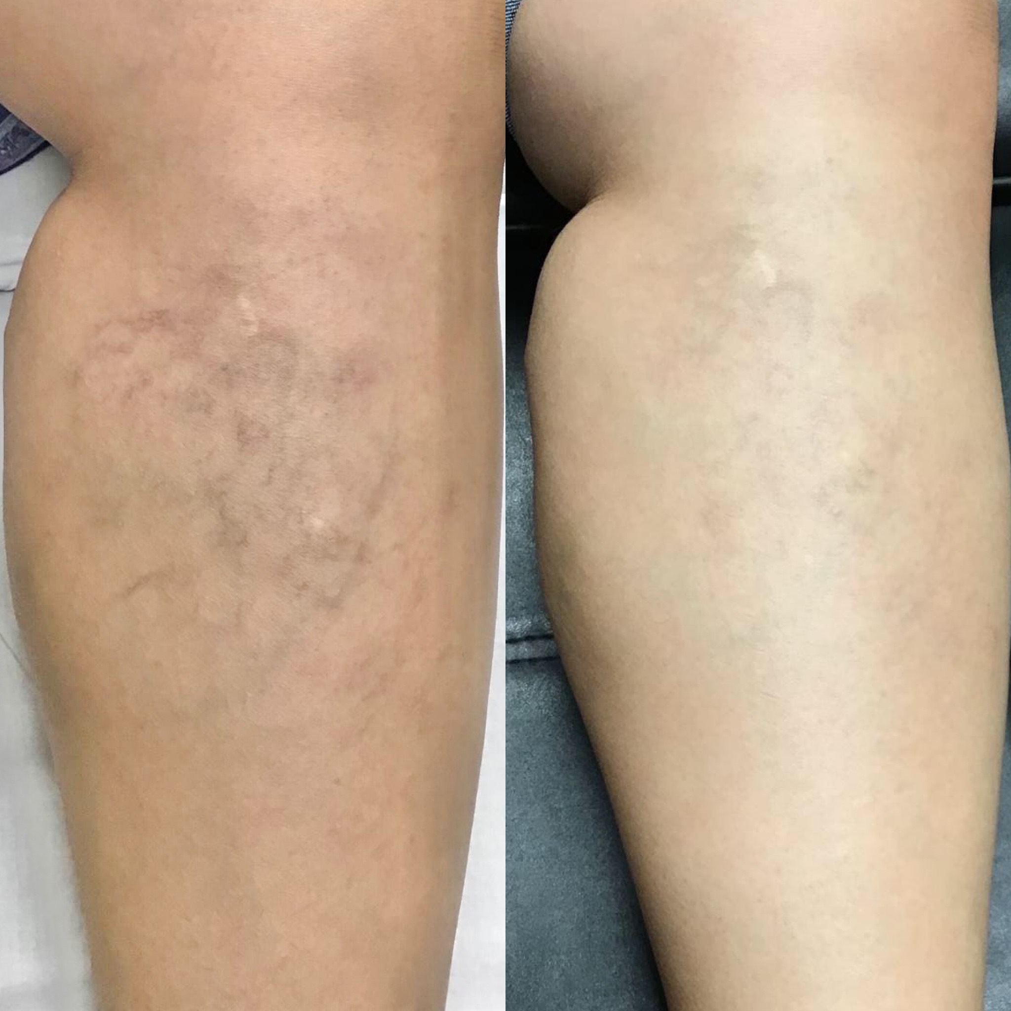 Before and After Image: Laser Vein Treatment - front